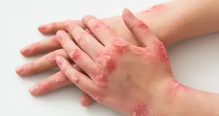 psoriasis.webp
